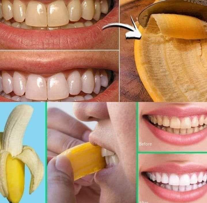 Secret That Dentists Don’t Want You to Know: Remove Tartar and Whiten Teeth in Just 2 Minutes with Banana Peel!