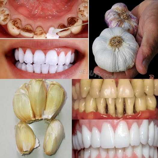 Secret Dentists Don’t Want You to Know: Remove Tartar and Whiten Teeth in Just 2 Minutes Using Garlic! ‎‎