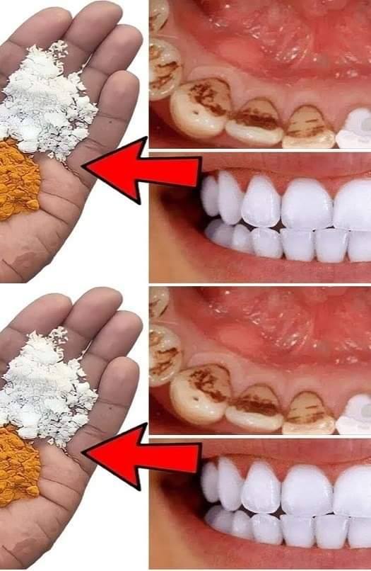 Brighten Your Smile: How to Whiten Yellow Teeth in Just 2 Minutes