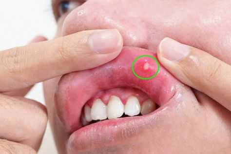 14 Best Home Remedies To Treat Mouth Ulcers