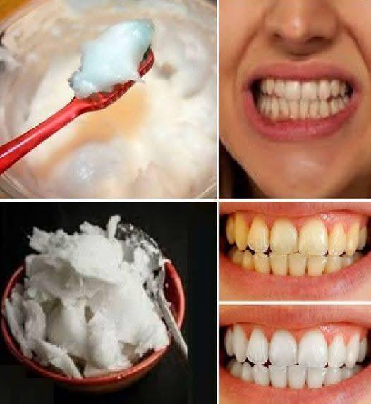 How to Naturally Whiten Your Teeth at Home in Just 3 Minutes Using Baking Soda and Coconut Oil