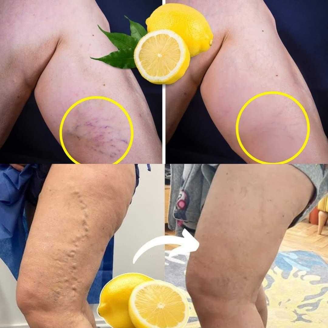 Lemon Removes Varicose Veins! Just Do This Every Day