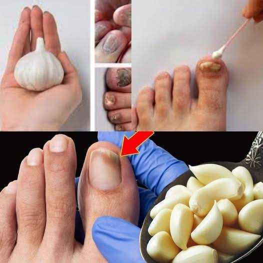 Nail Fungus? No Problem! Try this Natural Remedy!